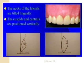 Teeth Setting Arrangement of teeth in complete denture | PPTX