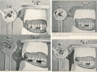Arrangement of teeth in complete denture | PPT
