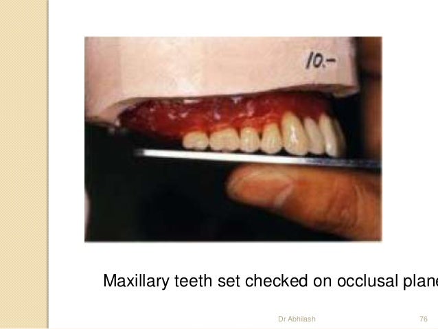 teeth setting