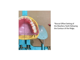 *Buccal Offset Setting of
the Maxillary Teeth following
the Contour of the Ridge.
 