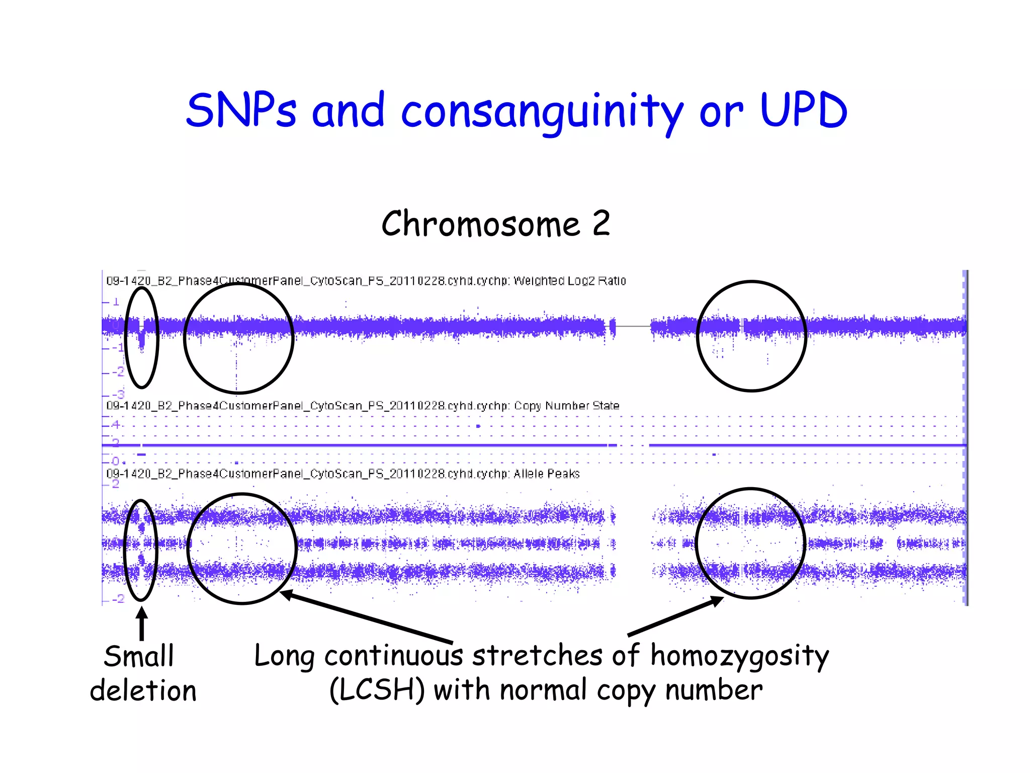 Chromosome 2
Small
deletion
Long continuous stretches of homozygosity
(LCSH) with normal copy number
SNPs and consanguinity or UPD