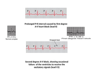 Prolonged P-R interval caused by first degree
A-V heart block (lead II)
Second degree A-V block, showing occasional
failure of the ventricles to receive the
excitatory signals (lead V3)
 