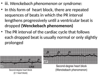 • iii. Wenckebach phenomenon or syndrome:
• In this form of heart block, there are repeated
sequences of beats in which the PR interval
lengthens progressively until a ventricular beat is
dropped (Wenckebach phenomenon)
• The PR interval of the cardiac cycle that follows
each dropped beat is usually normal or only slightly
prolonged
 