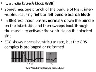 • iv. Bundle branch block (BBB):
• Sometimes one branch of the bundle of His is inter-
-rupted, causing right or left bundle branch block
• In BBB, excitation passes normally down the bundle
on the intact side and then sweeps back through
the muscle to activate the ventricle on the blocked
side
• ECG shows normal ventricular rate, but the QRS
complex is prolonged or deformed
Two V leads in left bundle branch block
 
