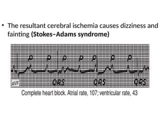 • The resultant cerebral ischemia causes dizziness and
fainting (Stokes–Adams syndrome)
 