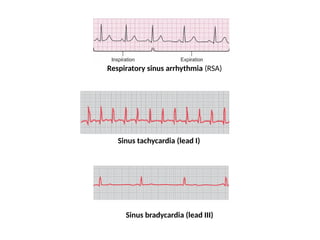 Respiratory sinus arrhythmia (RSA)
Sinus tachycardia (lead I)
Sinus bradycardia (lead III)
 