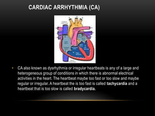 CARDIAC ARRHYTHMIA (CA)

• CA also known as dysrhythmia or irregular heartbeats is any of a large and
heterogeneous group of conditions in which there is abnormal electrical
activities in the heart. The heartbeat maybe too fast or too slow and maybe
regular or irregular. A heartbeat the is too fast is called tachycardia and a
heartbeat that is too slow is called bradycardia.

 