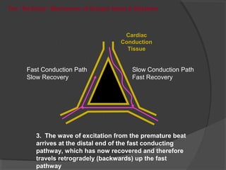 3. The wave of excitation from the premature beat
arrives at the distal end of the fast conducting
pathway, which has now recovered and therefore
travels retrogradely (backwards) up the fast
pathway
Fast Conduction Path
Slow Recovery
Slow Conduction Path
Fast Recovery
Cardiac
Conduction
Tissue
The “Re-Entry” Mechanism of Ectopic Beats & Rhythms
 