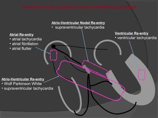 Atrial Re-entry
• atrial tachycardia
• atrial fibrillation
• atrial flutter
Atrio-Ventricular Re-entry
• Wolf Parkinson White
• supraventricular tachycardia
Ventricular Re-entry
• ventricular tachycardia
Atrio-Ventricular Nodal Re-entry
• supraventricular tachycardia
Re-entry Circuits as Ectopic Foci and Arrhythmia Generators
 