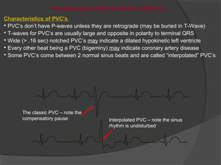Recognizing and Naming Beats & Rhythms
Characteristics of PVC's
• PVC’s don’t have P-waves unless they are retrograde (may be buried in T-Wave)
• T-waves for PVC’s are usually large and opposite in polarity to terminal QRS
• Wide (> .16 sec) notched PVC’s may indicate a dilated hypokinetic left ventricle
• Every other beat being a PVC (bigeminy) may indicate coronary artery disease
• Some PVC’s come between 2 normal sinus beats and are called “interpolated” PVC’s
Interpolated PVC – note the sinus
rhythm is undisturbed
The classic PVC – note the
compensatory pause
 