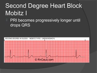 Second Degree Heart Block
Mobitz I
 PRI becomes progressively longer until
drops QRS
 