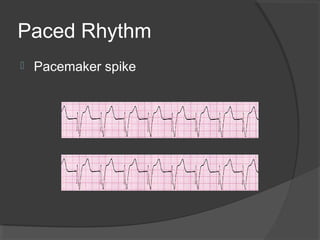 Paced Rhythm
 Pacemaker spike
 