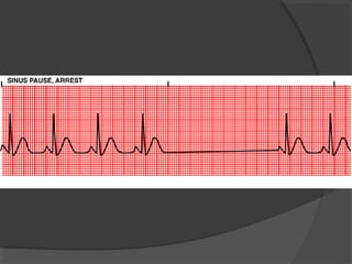 Arrhythmia | PPT