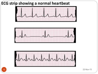 22-Nov-1512
ECG strip showing a normal heartbeat
 