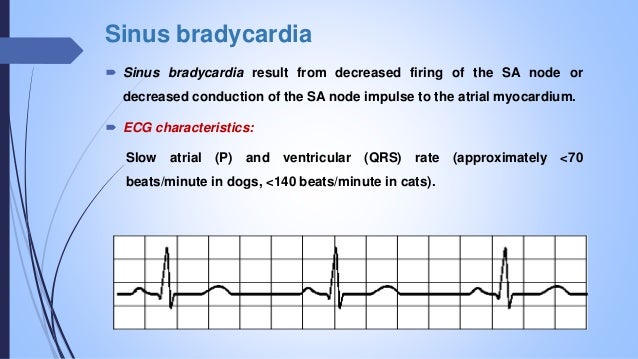 Arrhythmia Arrhythmia