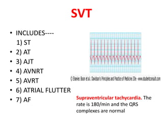 CARDIAC ARRHYTHMIAS | PPTX
