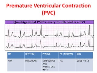 Irregular Pvc CARDIAC ARRHYTHMIAS | PPTX