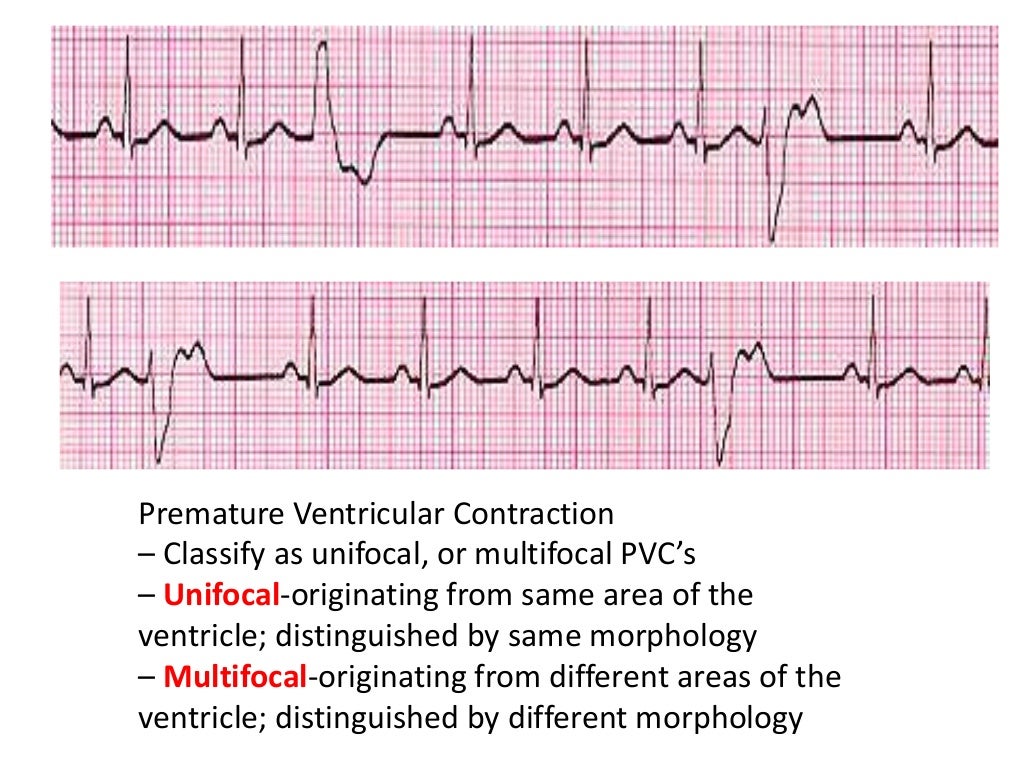 CARDIAC ARRHYTHMIAS