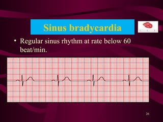 Sinus bradycardia
• Regular sinus rhythm at rate below 60
beat/min.
26
 