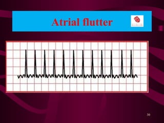 Atrial flutter
30
 