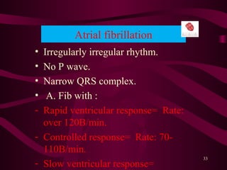 Atrial fibrillation
• Irregularly irregular rhythm.
• No P wave.
• Narrow QRS complex.
• A. Fib with :
- Rapid ventricular response= Rate:
over 120B/min.
- Controlled response= Rate: 70-
110B/min.
- Slow ventricular response=
33
 