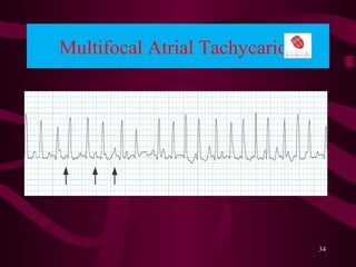 Multifocal Atrial Tachycarida
34
 