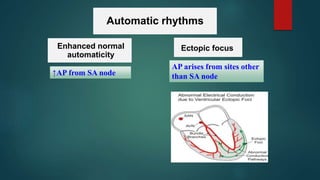 Automatic rhythms
Enhanced normal
automaticity
Ectopic focus
↑AP from SA node
AP arises from sites other
than SA node
 