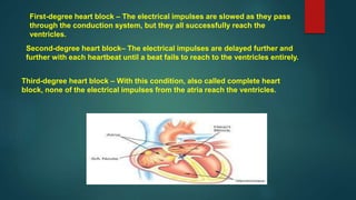First-degree heart block – The electrical impulses are slowed as they pass
through the conduction system, but they all successfully reach the
ventricles.
Second-degree heart block– The electrical impulses are delayed further and
further with each heartbeat until a beat fails to reach to the ventricles entirely.
Third-degree heart block – With this condition, also called complete heart
block, none of the electrical impulses from the atria reach the ventricles.
 