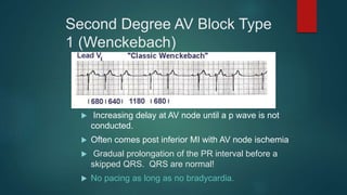 Second Degree AV Block Type
1 (Wenckebach)
 Increasing delay at AV node until a p wave is not
conducted.
 Often comes post inferior MI with AV node ischemia
 Gradual prolongation of the PR interval before a
skipped QRS. QRS are normal!
 No pacing as long as no bradycardia.
 