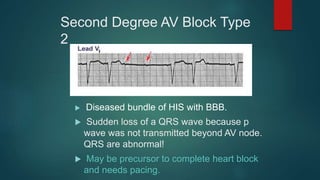 Second Degree AV Block Type
2
 Diseased bundle of HIS with BBB.
 Sudden loss of a QRS wave because p
wave was not transmitted beyond AV node.
QRS are abnormal!
 May be precursor to complete heart block
and needs pacing.
 