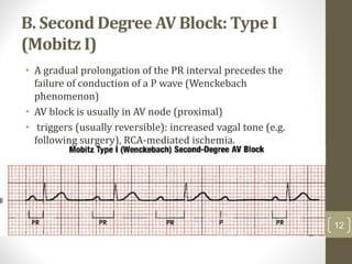 B. Second Degree AV Block: Type I
(Mobitz I)
• A gradual prolongation of the PR interval precedes the
failure of conduction of a P wave (Wenckebach
phenomenon)
• AV block is usually in AV node (proximal)
• triggers (usually reversible): increased vagal tone (e.g.
following surgery), RCA-mediated ischemia.
12
 