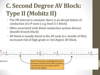 C. Second Degree AV Block:
Type II (Mobitz II)
• The PR interval is constant; there is an abrupt failure of
conduction of a P wave ( e.g. fixed 2:1 block)
• Often associated with distal conduction system disease
(bundle branch block)
• AV block is usually distal to the AV node (i.e. bundle of His);
increased risk of high grade or 3rd degree AV block.
13
 