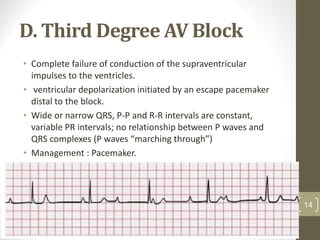 D. Third Degree AV Block
• Complete failure of conduction of the supraventricular
impulses to the ventricles.
• ventricular depolarization initiated by an escape pacemaker
distal to the block.
• Wide or narrow QRS, P-P and R-R intervals are constant,
variable PR intervals; no relationship between P waves and
QRS complexes (P waves “marching through”)
• Management : Pacemaker.
14
 