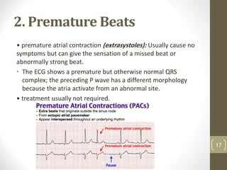 2. Premature Beats
• premature atrial contraction (extrasystoles): Usually cause no
symptoms but can give the sensation of a missed beat or
abnormally strong beat.
• The ECG shows a premature but otherwise normal QRS
complex; the preceding P wave has a different morphology
because the atria activate from an abnormal site.
• treatment usually not required.
17
 
