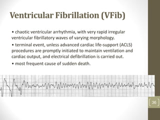 Ventricular Fibrillation (VFib)
• chaotic ventricular arrhythmia, with very rapid irregular
ventricular fibrillatory waves of varying morphology.
• terminal event, unless advanced cardiac life-support (ACLS)
procedures are promptly initiated to maintain ventilation and
cardiac output, and electrical defibrillation is carried out.
• most frequent cause of sudden death.
36
 