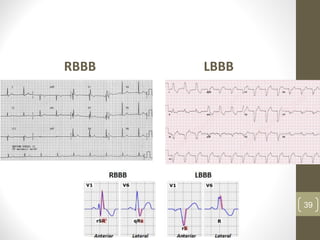 RBBB LBBB
39
 