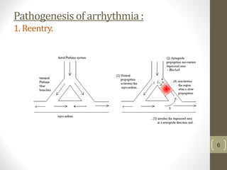 Pathogenesis of arrhythmia :
1. Reentry.
6
 