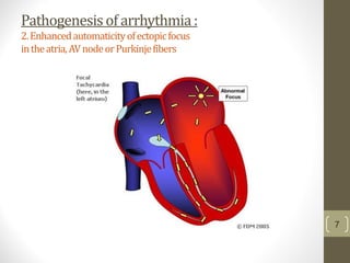 Pathogenesisof arrhythmia:
2.Enhancedautomaticityofectopicfocus
intheatria,AVnodeorPurkinjefibers
7
 