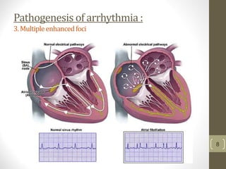 Pathogenesis of arrhythmia :
3.Multipleenhancedfoci
8
 