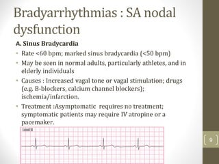 Bradyarrhythmias : SA nodal
dysfunction
A. Sinus Bradycardia
• Rate <60 bpm; marked sinus bradycardia (<50 bpm)
• May be seen in normal adults, particularly athletes, and in
elderly individuals
• Causes : Increased vagal tone or vagal stimulation; drugs
(e.g. B-blockers, calcium channel blockers);
ischemia/infarction.
• Treatment :Asymptomatic requires no treatment;
symptomatic patients may require IV atropine or a
pacemaker.
9
 