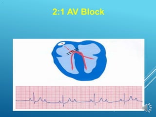2:1 AV Block
 