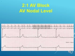 2:1 AV Block
AV Nodal Level
 