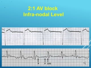 2:1 AV block
Infra-nodal Level
 