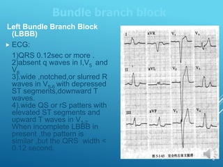 Left Bundle Branch Block
(LBBB)
 ECG:
1)QRS 0.12sec or more .
2)absent q waves in I,V5 and
V6
3).wide ,notched,or slurred R
waves in V5-6 with depressed
ST segments,downward T
waves.
4).wide QS or rS patters with
elevated ST segments and
upward T waves in V1-2.
When incomplete LBBB in
present ,the pattern is
similar ,but the QRS width <
0.12 second.
Bundle branch block
 