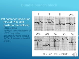 left posterior fascicular
block(LPH) (left
posterior hemiblock)
ECG criteria
1) Right axis deviation of
+120 or greater
2).Large S wave in lead I
3) Tall R waves in lead II
and III.
Bundle branch block
 