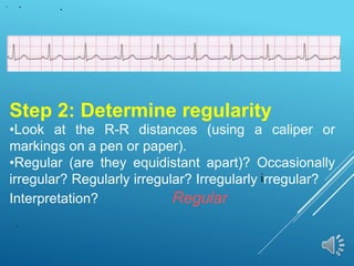 Step 2: Determine regularity
•Look at the R-R distances (using a caliper or
markings on a pen or paper).
•Regular (are they equidistant apart)? Occasionally
irregular? Regularly irregular? Irregularly irregular?
Interpretation? Regular
 