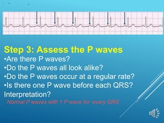 Step 3: Assess the P waves
•Are there P waves?
•Do the P waves all look alike?
•Do the P waves occur at a regular rate?
•Is there one P wave before each QRS?
Interpretation?
Normal P waves with 1 P wave for every QRS
 