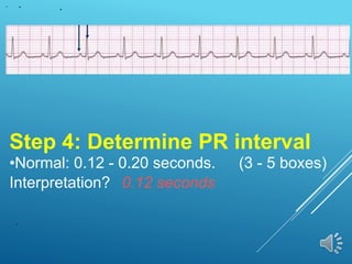 Step 4: Determine PR interval
•Normal: 0.12 - 0.20 seconds. (3 - 5 boxes)
Interpretation? 0.12 seconds
 