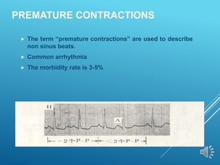 PREMATURE CONTRACTIONS
 The term “premature contractions” are used to describe
non sinus beats.
 Common arrhythmia
 The morbidity rate is 3-5%
 