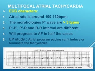 MULTIFOCAL ATRIAL TACHYCARDIA
 ECG characters:
1. Atrial rate is around 100-130bpm;
2. The morphologies P’ wave are > 3 types.
3. P’-P’, P’-R and R-R interval are different.
4. Will progress to AF in half the cases
5. EP study : Atrial program pacing can’t induce or
terminate the tachycardia
 